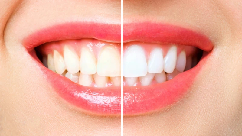 Before and After Teeth Whitening: What Should You Expect?