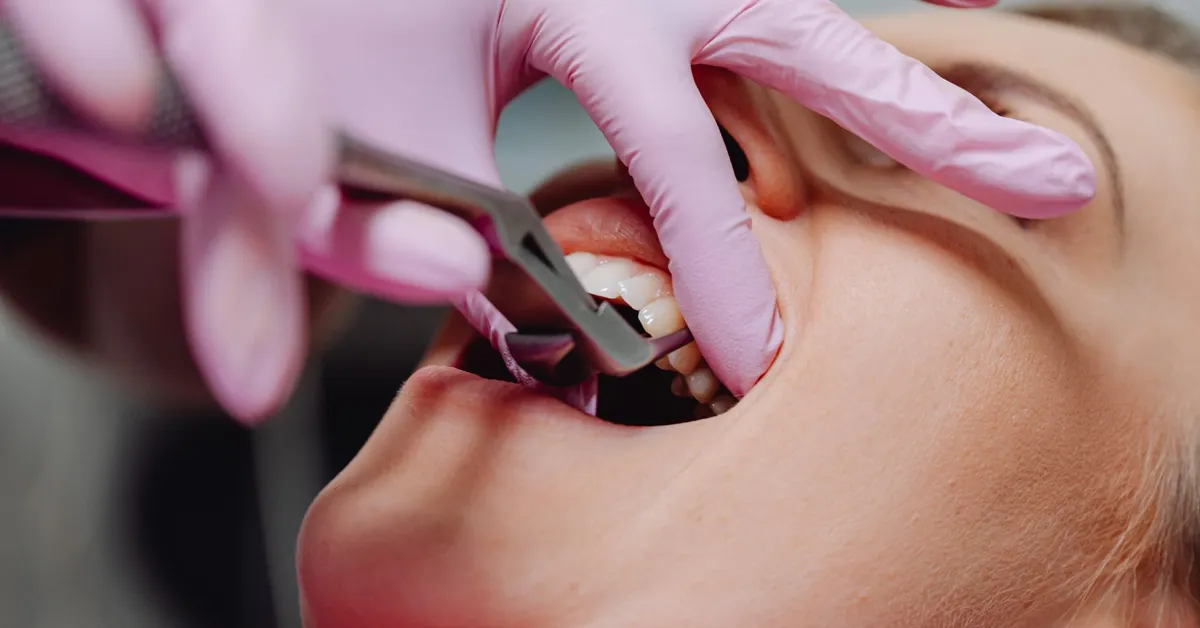 Normal Tooth Extraction (Difficult/Complicated Extractions)
