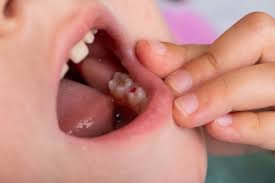 Çocuklarda dolgu tedavisi,çocuk ağız ve diş sağlığı,pedodontist,diş dolgusu,Dolgu Tedavisi,Kahramanmaraş Dolgu Tedavisi