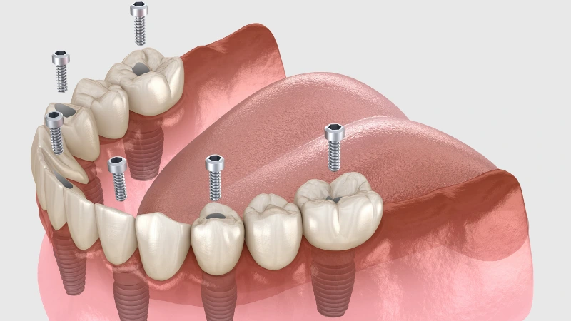 all on six implant fiyatlari