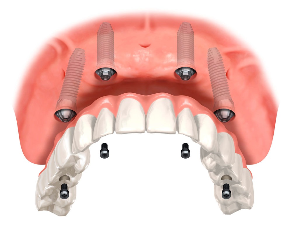 blog implant cene