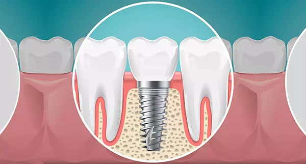 implant 1