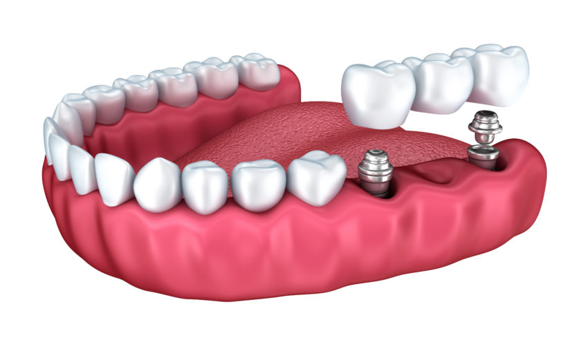 implant tedavisi e1538842576941