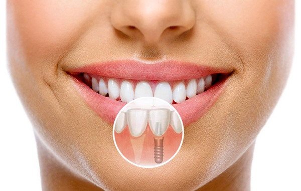 implant
