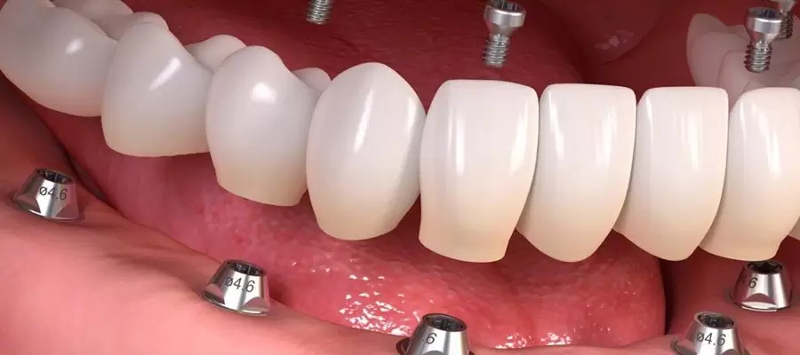 kahramanmaraş implant ömrü