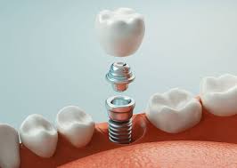 kahramanmaraş dental İmplant uygulaması